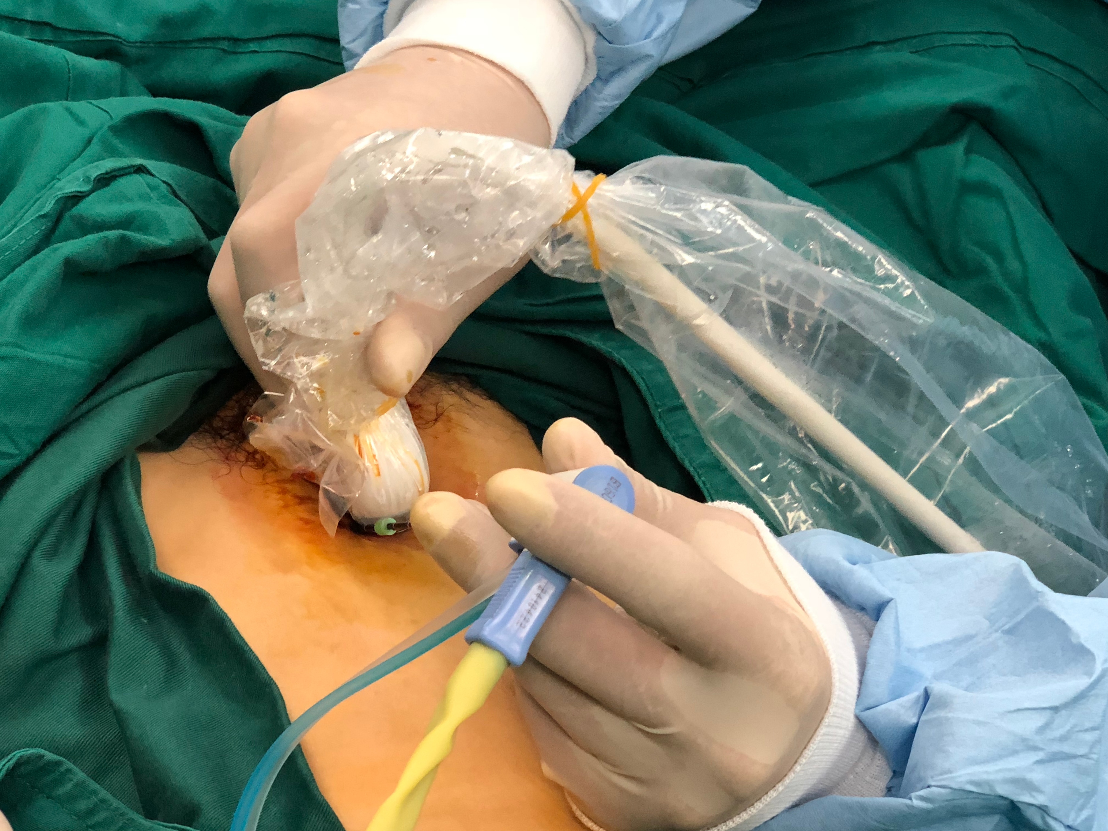 漯河治疗子宫肌瘤最好,齐鲁医院治疗子宫肌瘤最好的专家