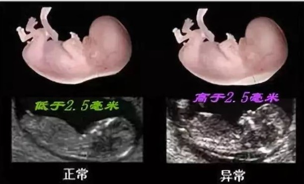 孕妇nt值超标什么导致的,nt染色体异常风险