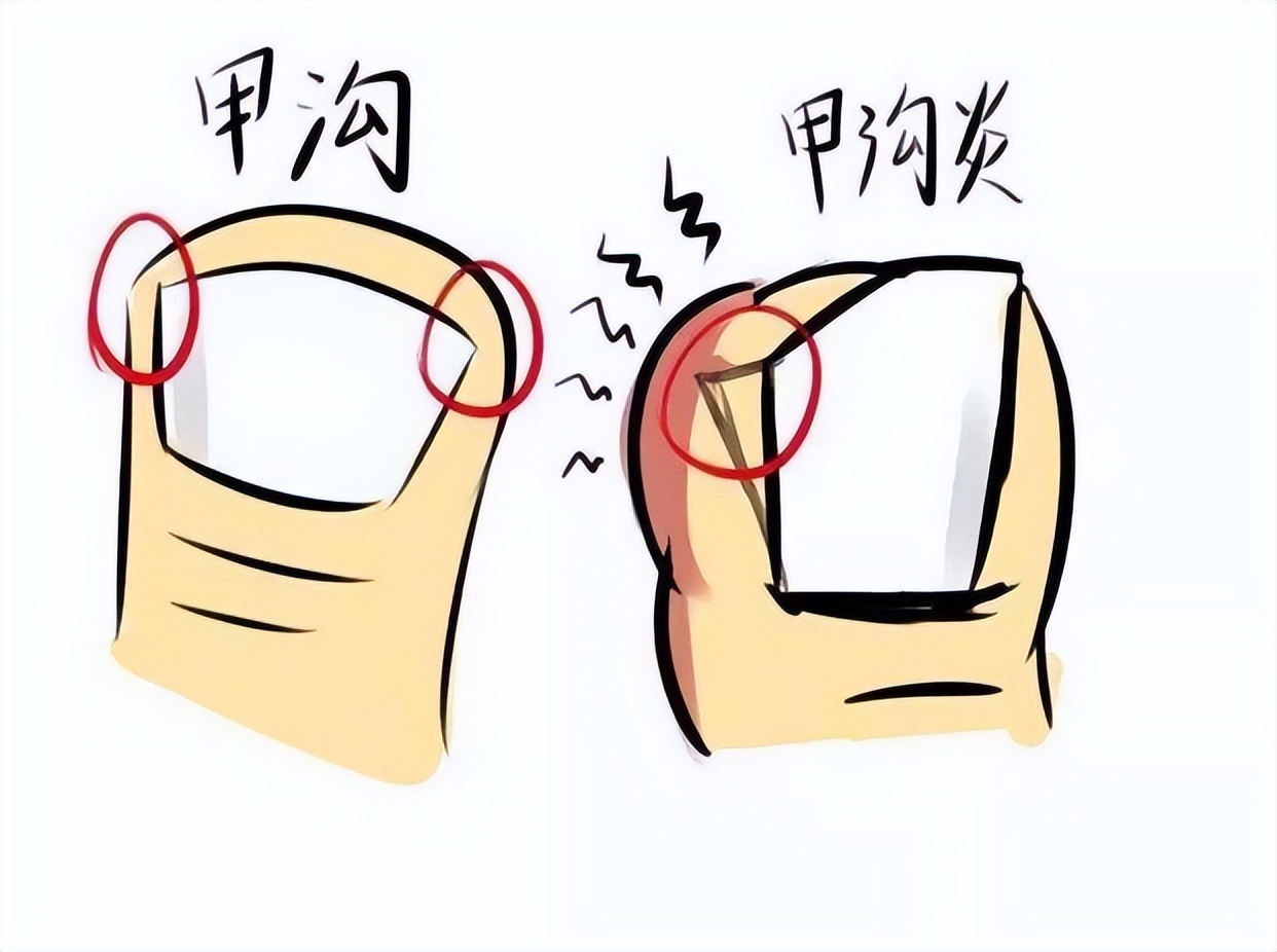 甲沟炎痛的无法剪指甲怎么办,甲沟炎清理过了为什么还是痛