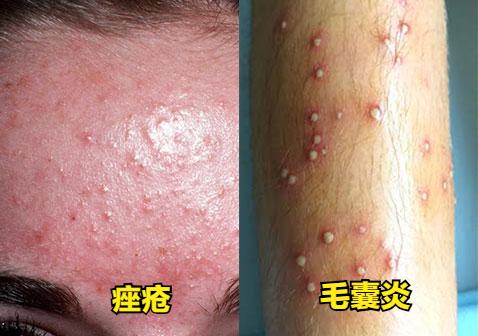如何区分毛囊炎疖肿和痤疮,疮和疖子怎么区分