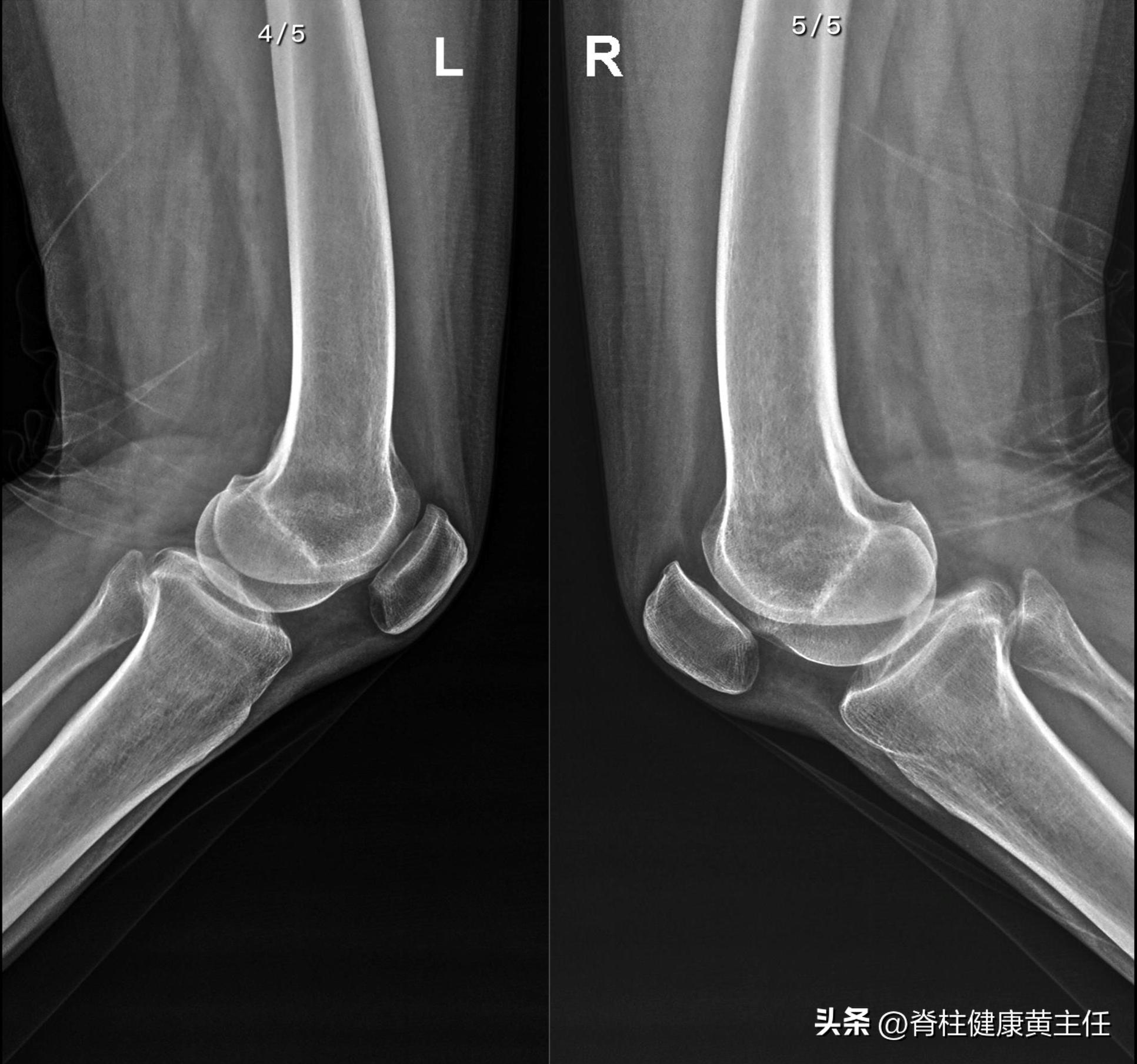 膝关节疼痛不是风湿是什么引起的,髌骨上移膝痛1分钟解决