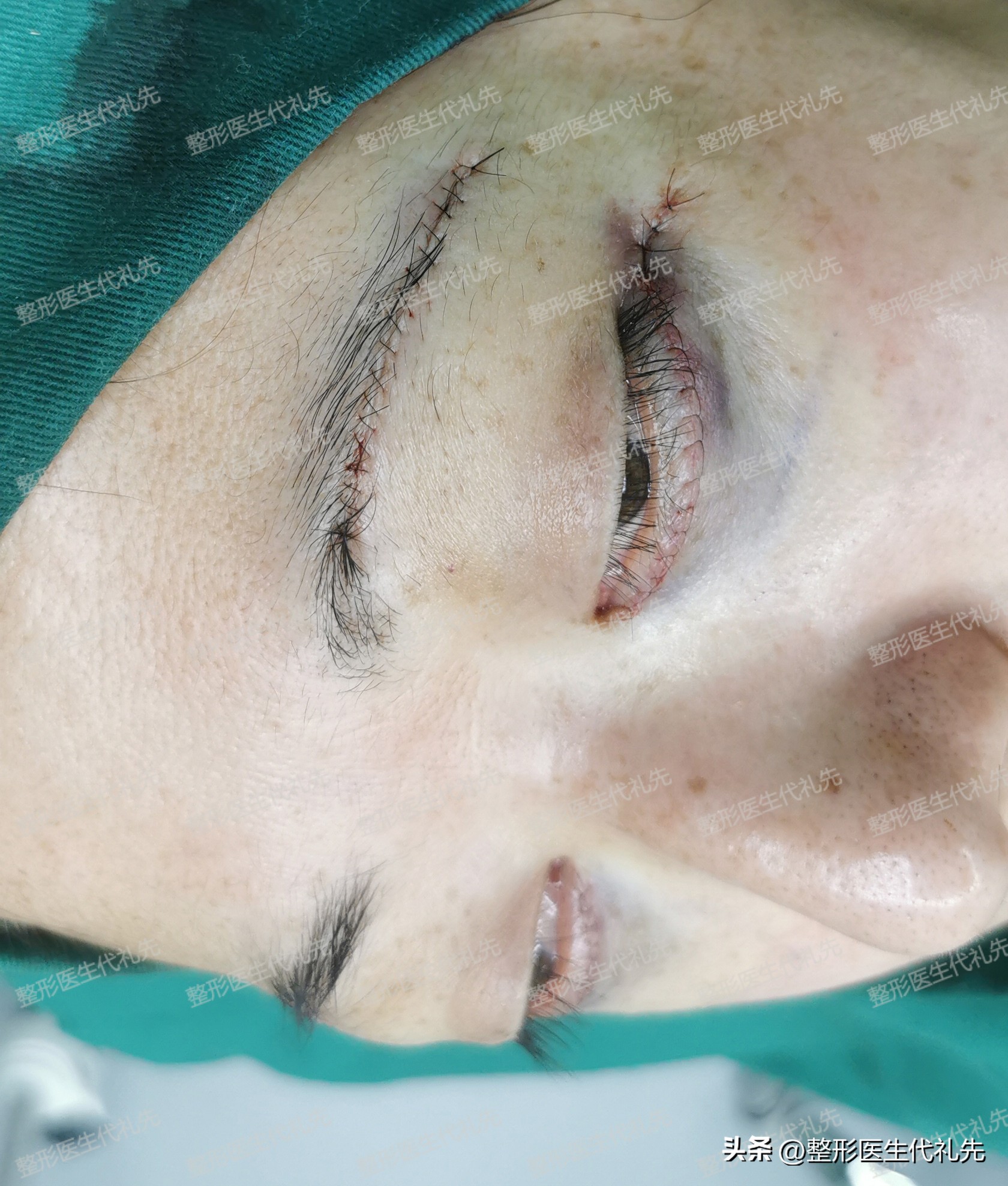 祛眼袋手术后有细纹会慢慢恢复吗,祛眼袋两年后眼睛凹陷怎么办