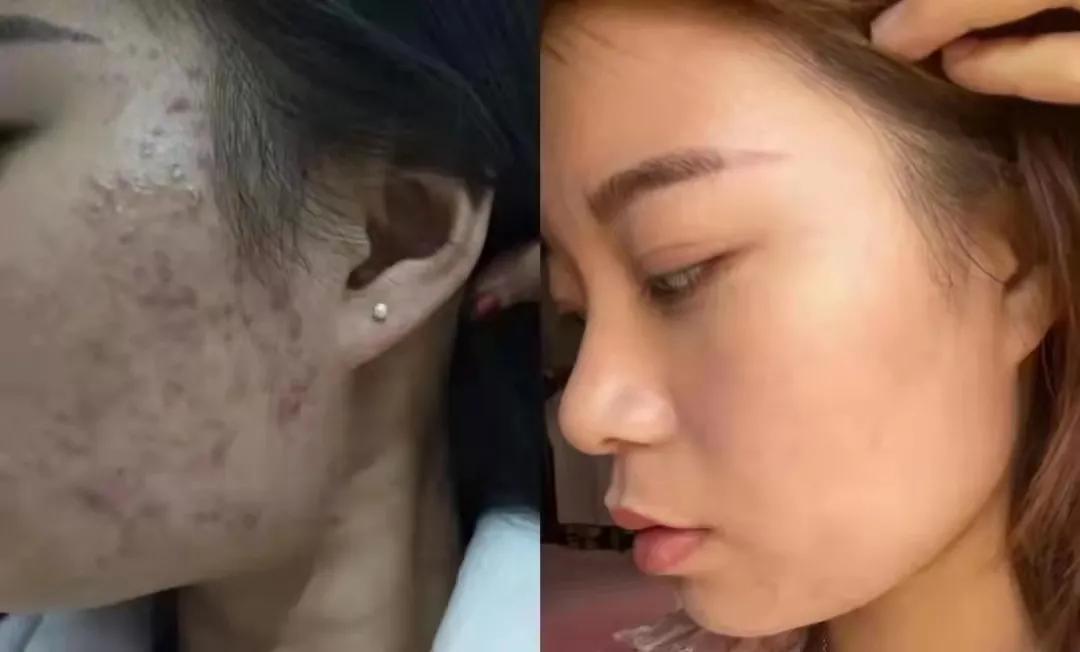 同一地方反复长痘怎么办,同一个位置反复长痘痘怎么根治