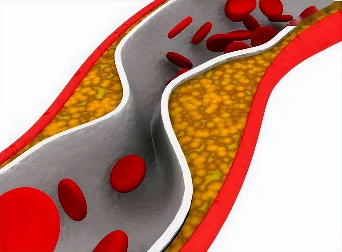 低密度脂蛋白高的2个解决办法,低密度脂蛋白偏高怎么才能降下来