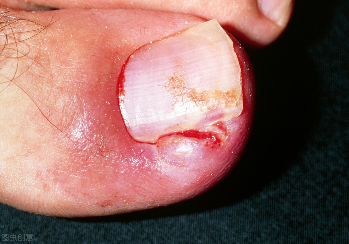 指甲剪太短导致的甲沟炎怎么办,指甲剪的太深了怎样预防甲沟炎