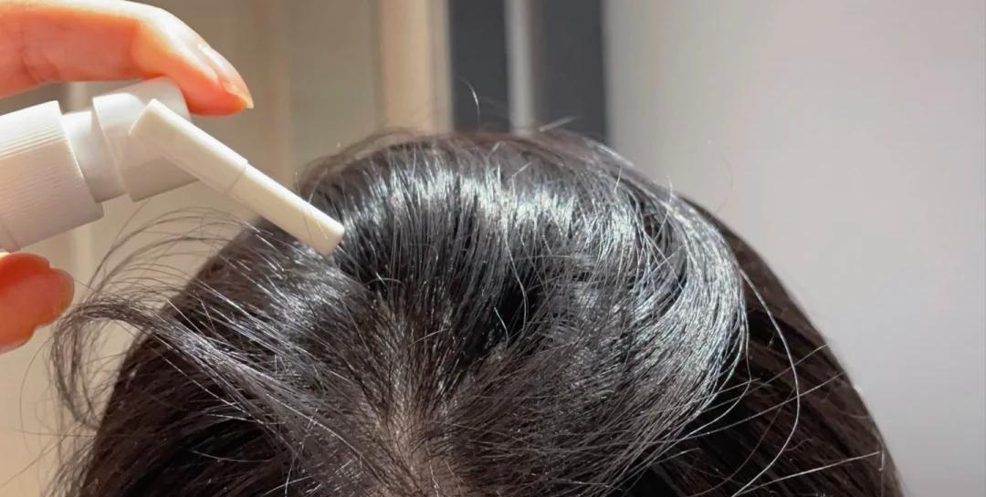 用米诺地尔两个星期疯狂掉头发 (使用米诺地尔期间掉头发更多了)