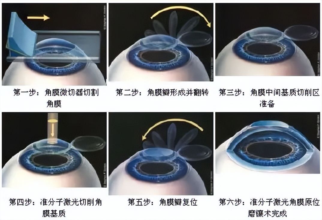 准分子治疗近视眼有后遗症吗,准分子近视眼手术价格多少