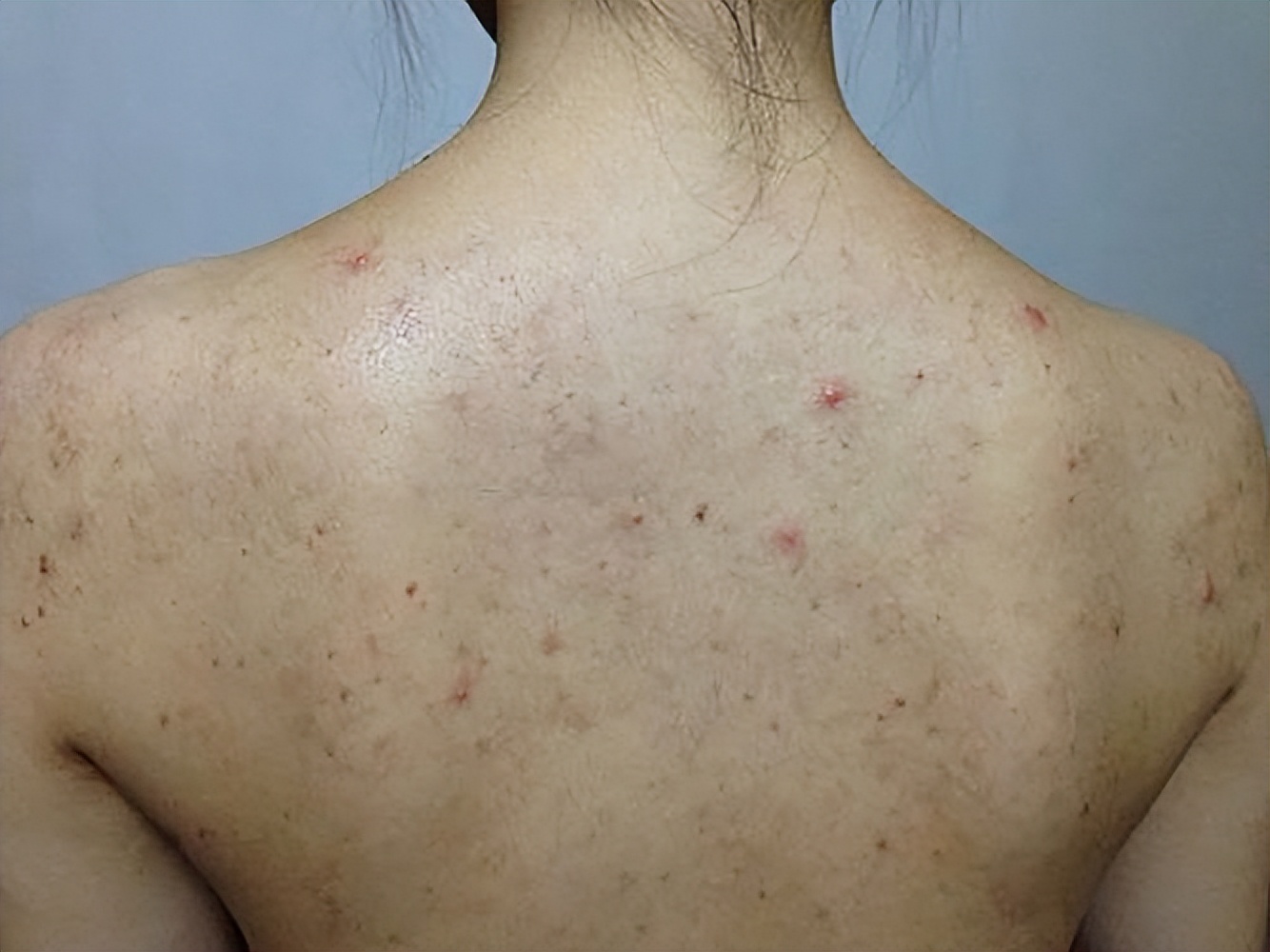 湖南校花坚持用硫磺皂洗头,用硫磺皂洗澡坚持了一年