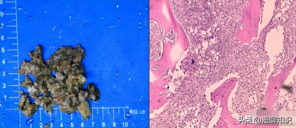 慢性复发性骨髓炎儿童案例,青少年得慢性骨髓炎能治好吗