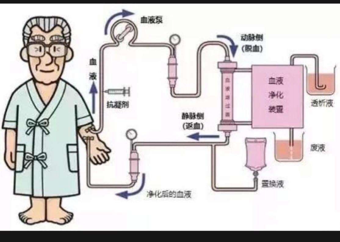 透析失衡综合征症状多久消失,透析过程中失衡综合征的原因