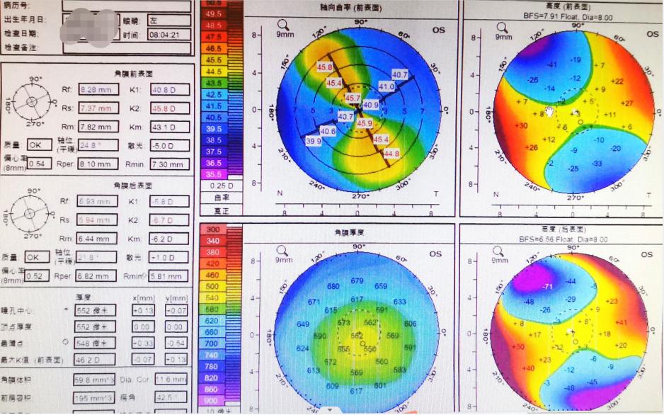南阳市南石眼科全飞秒激光多少钱,南阳南石医院飞秒价格