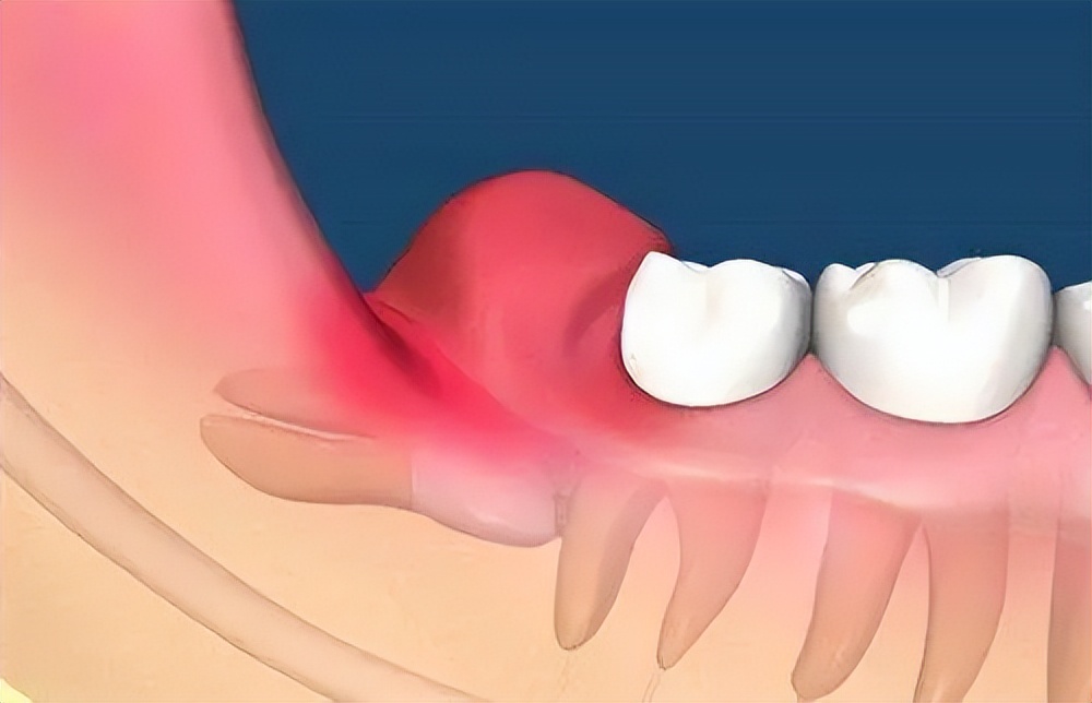 起床牙龈流血,早上起床嘴里发苦并且牙龈出血