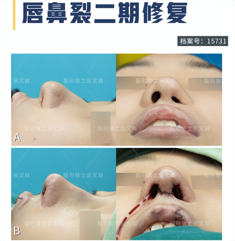 兔唇可以修复吗,兔唇修复能和正常人一样吗