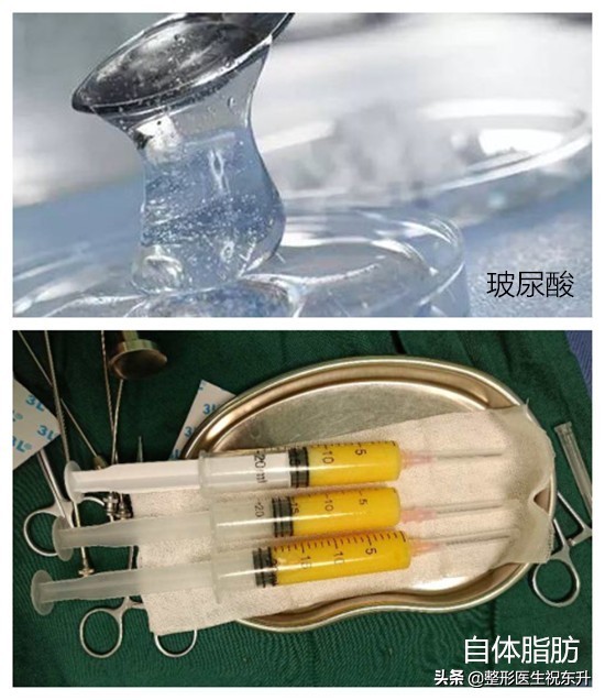 额头不饱满用什么填充最好,颞骨凹陷适合填充什么