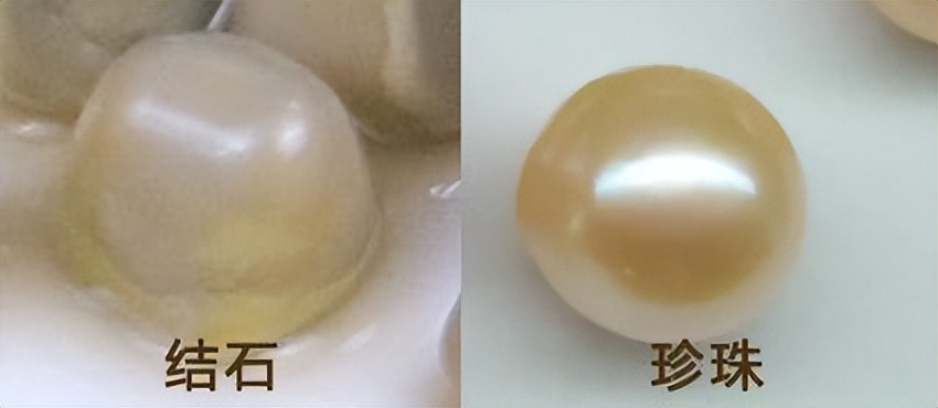 胆囊结石一般是什么色,胆囊结石的形状像米粒