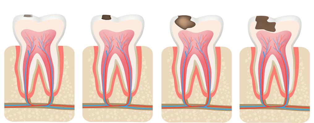 恒齿龋齿怎么治,牙医去除龋齿