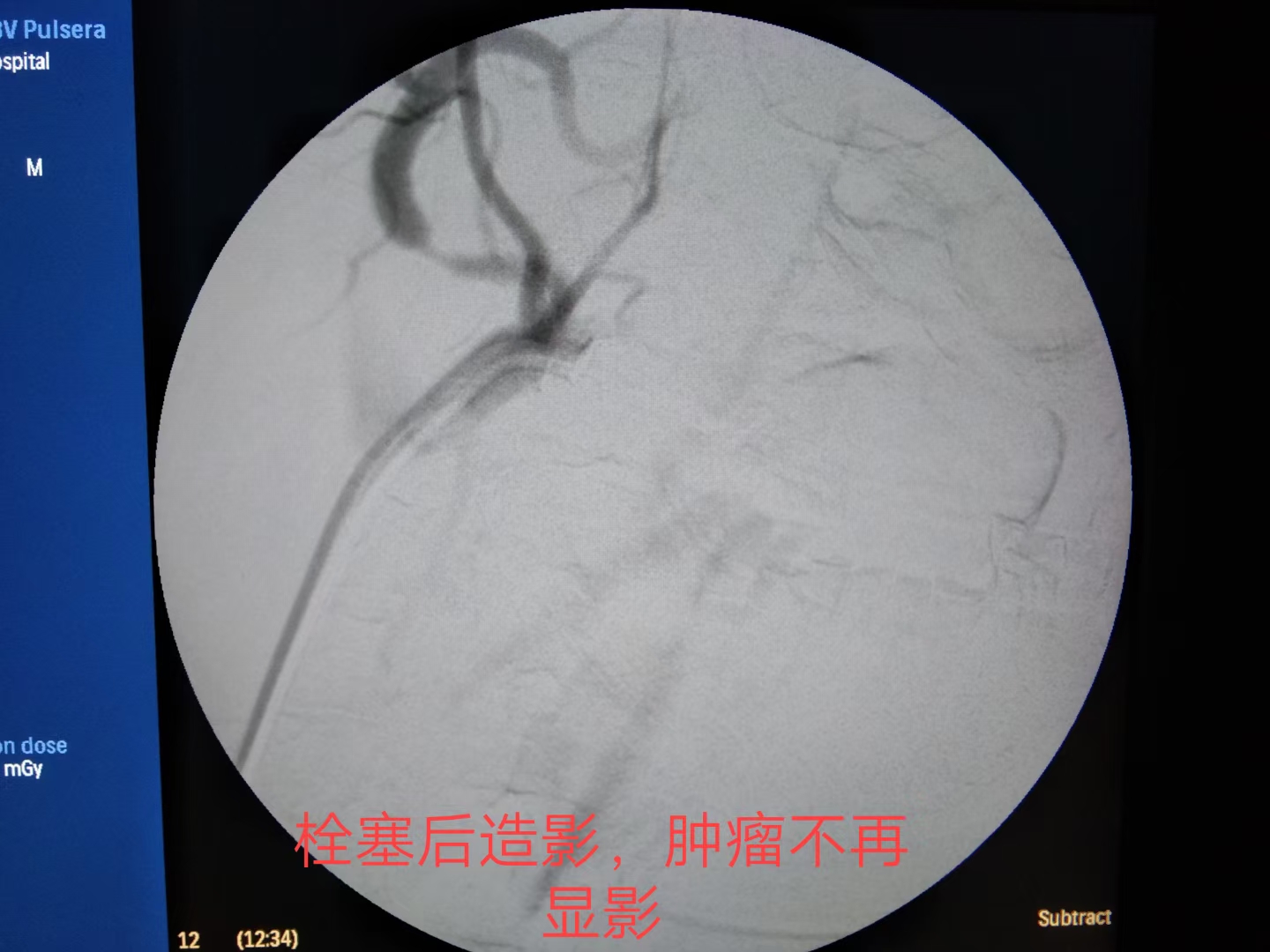 「病例分享」舌癌患者突发大出血，燥动不安，介入治疗成功止血