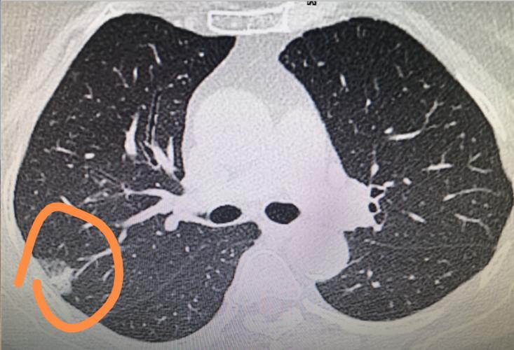 肺结节患者吃虾的好处和坏处,肺结节能不能吃大虾