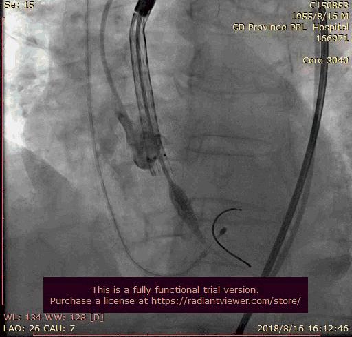 主动脉瓣狭窄的典型三联征表现,主动脉瓣狭窄治疗新技术