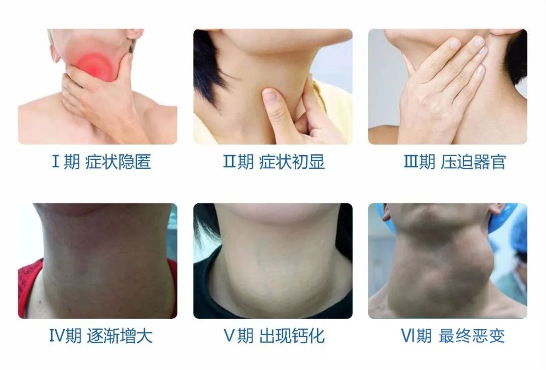 甲状腺结节该如何规范化治疗？