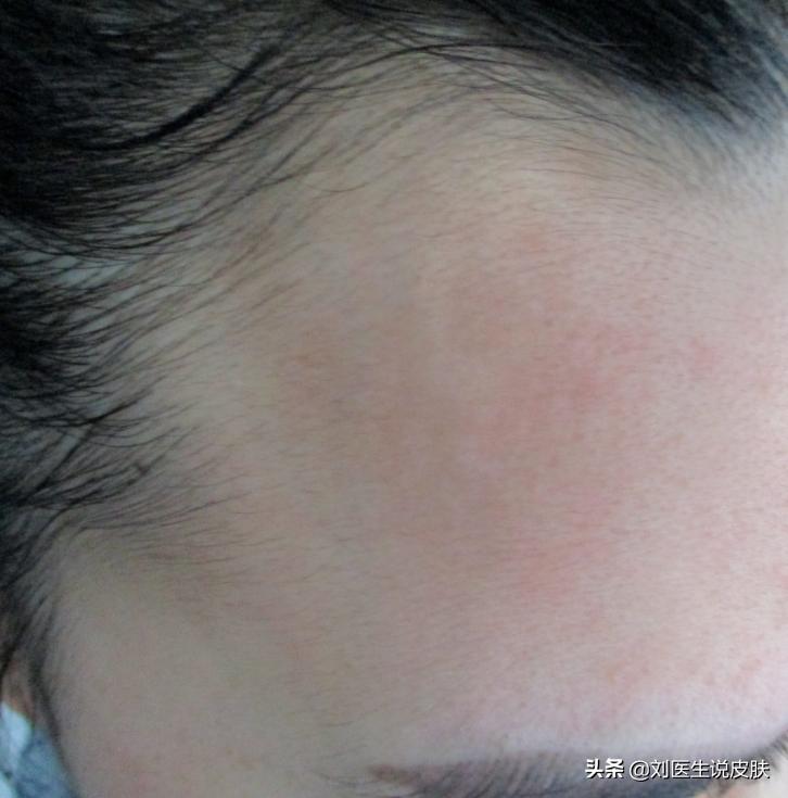 额头白斑，生姜涂擦后扩散怎么办？医生1个方案，治白又快又好