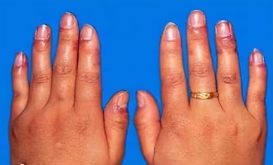 风湿免疫类疾病最怕什么,风湿免疫疾病如何预防