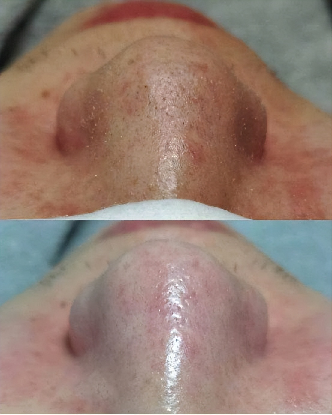 清洁面膜可以去黑头粉刺闭口吗,清洁面膜可以去除黑头吗