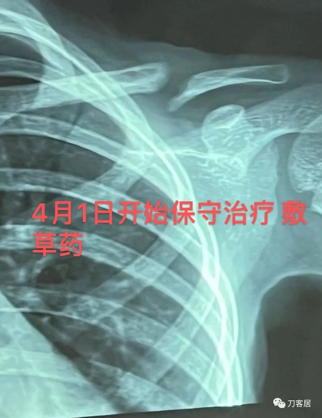 儿童锁骨骨折保守治疗的弊端,锁骨粉碎骨折错位不处理会愈合吗