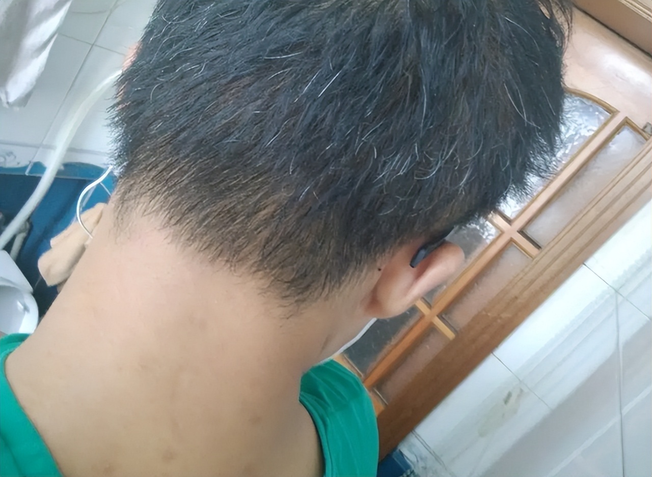 前额和头顶白发多怎么回事,右前额长白发代表什么