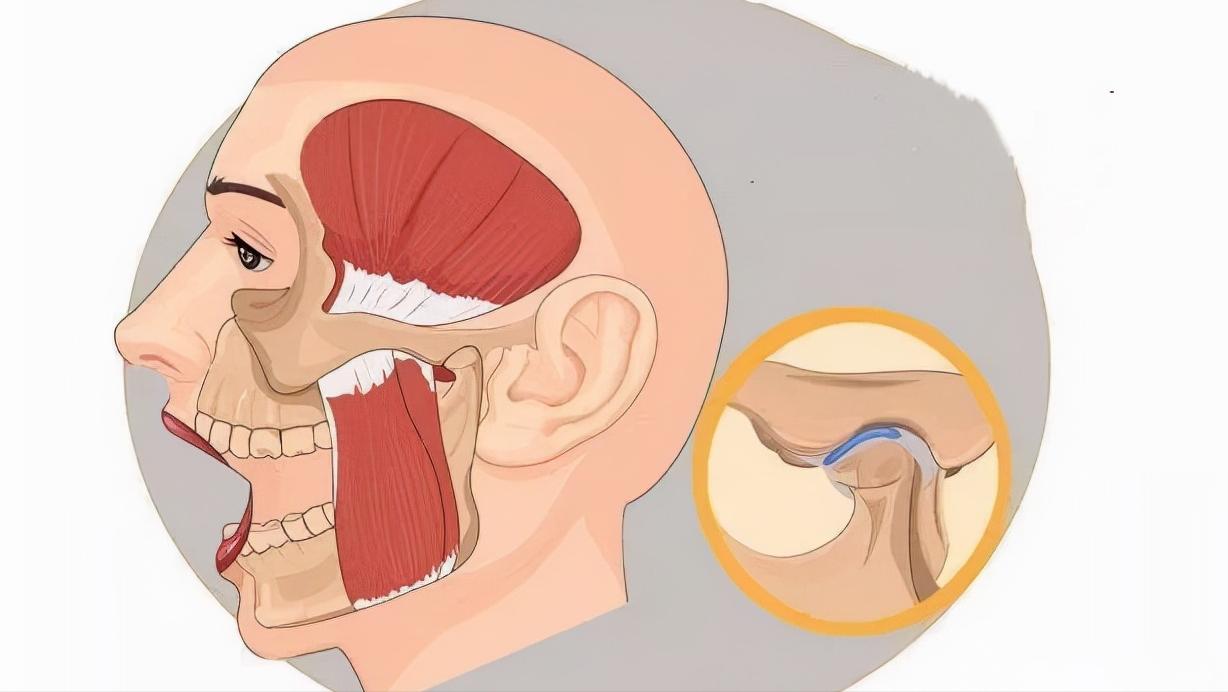 张嘴发出咔咔咔的声音,张嘴腮帮子咔哒响还疼怎么治