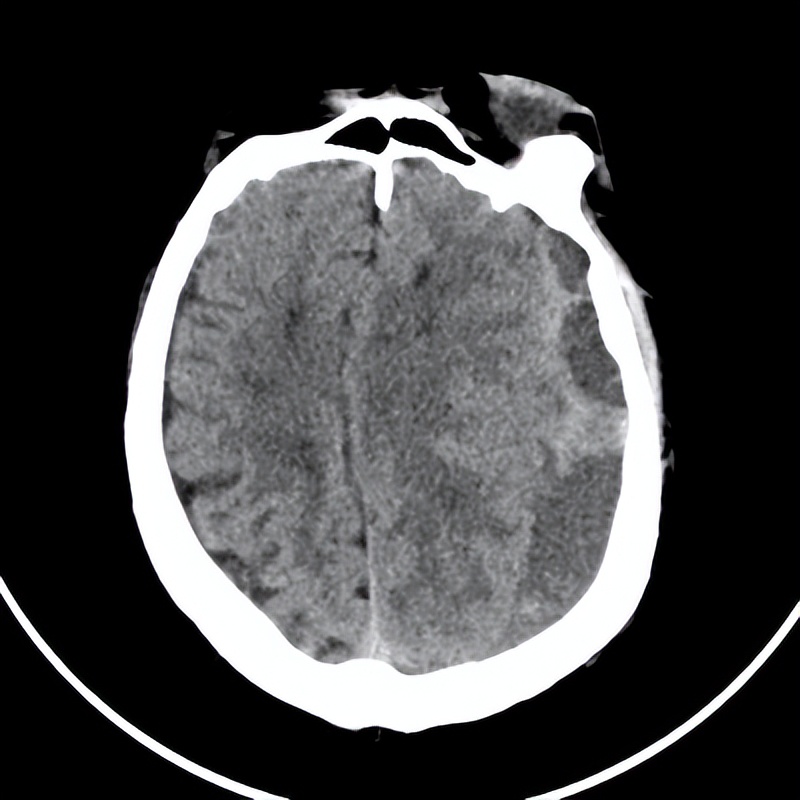 老人摔倒致硬膜下血肿哈医大一院神外梁洪生20分钟快速清除！