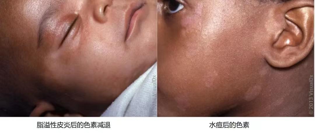 18种皮肤病白斑病,常见皮肤病斑