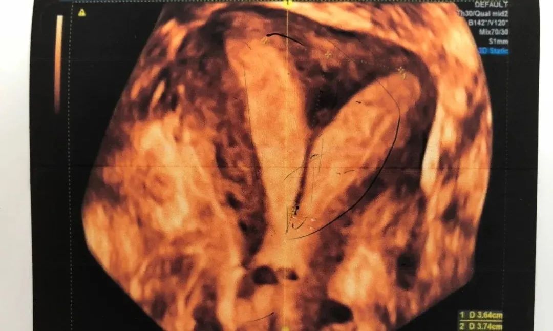 医生，B超提示我有子宫畸形，怎么办？