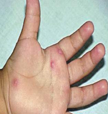 宝宝健康学堂全集,宝宝病毒感染嘴巴手脚里面长疱疹