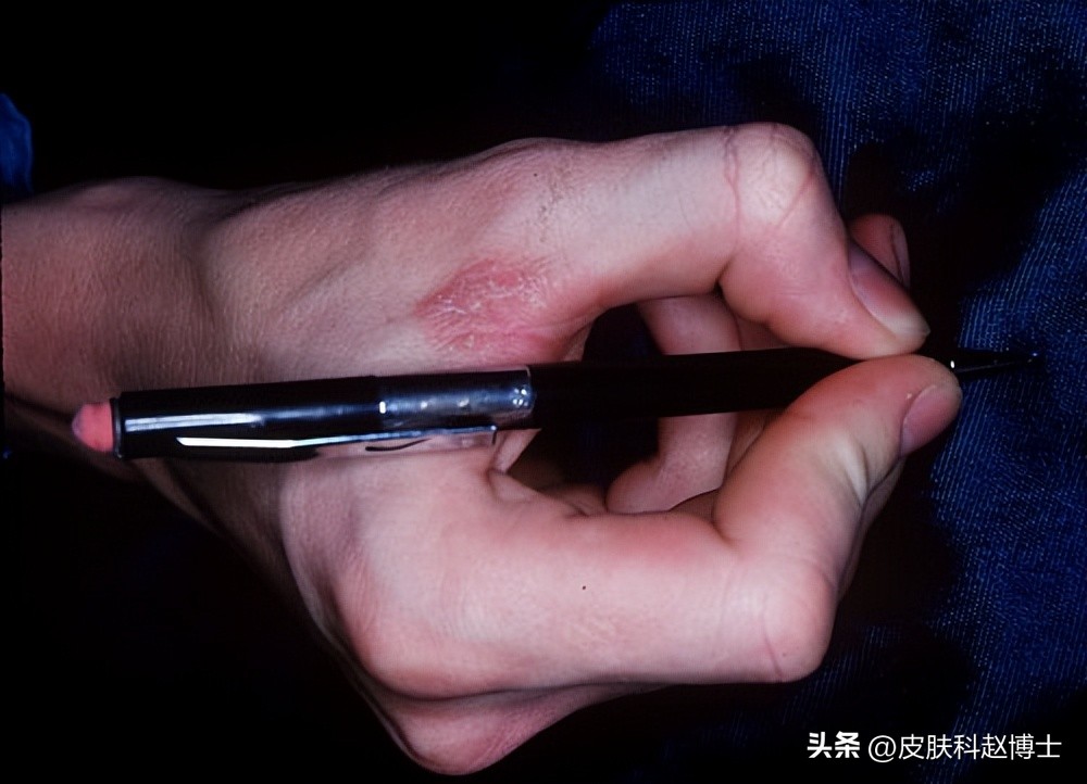 过敏湿疹反复发作如何除根,湿疹反复发作找不到病因