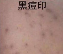 痘痘的10个秘密,痘痘告诉你身体的秘密