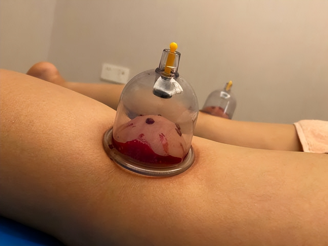 刺络拔罐治什么病,刺络拔罐全过程