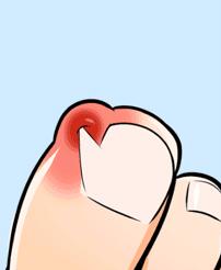 一走路脚趾甲疼,一走路脚趾疼是怎么回事