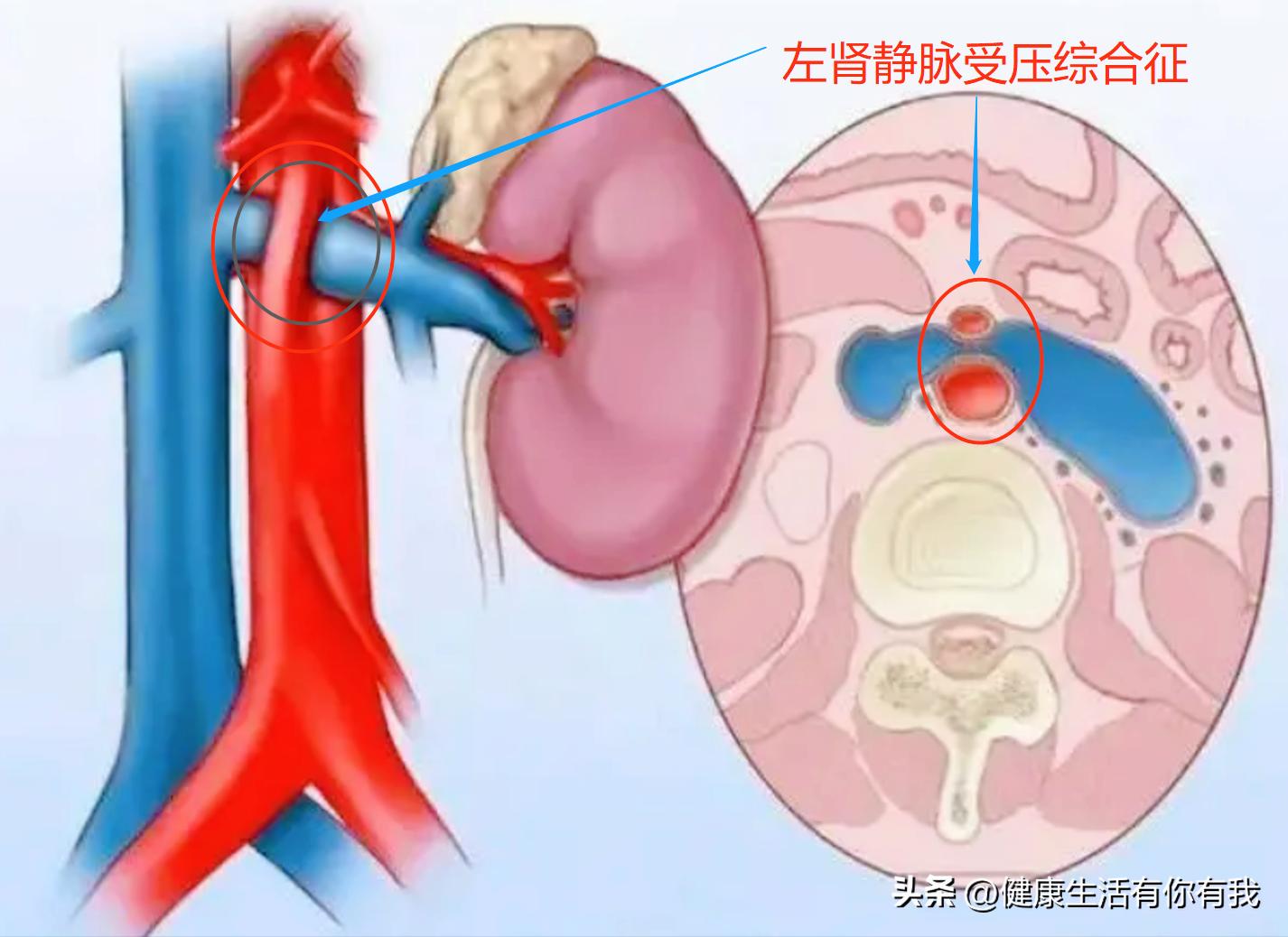 什么是血尿和尿潜血,什么是血尿是怎么回事