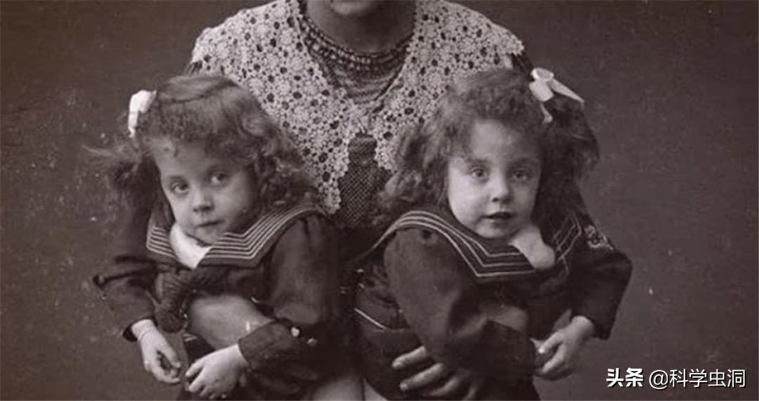 连体姐妹其中一个人死了怎么办,连体姐妹一个死了另一个咋办