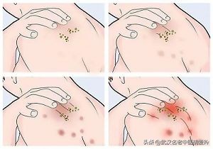 头皮红疙瘩奇痒无比,红疙瘩很痒有硬块一直不消退