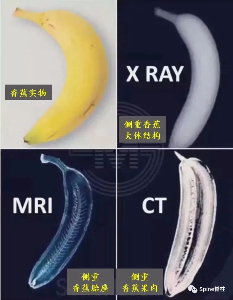 腰椎间盘突出症状表现,腰椎间盘突出症疼痛最佳止痛方法