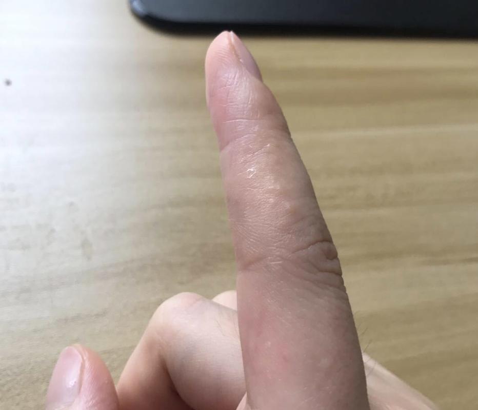 天气变热手指上出现汗疱疹,准备下雨手就长疱疹