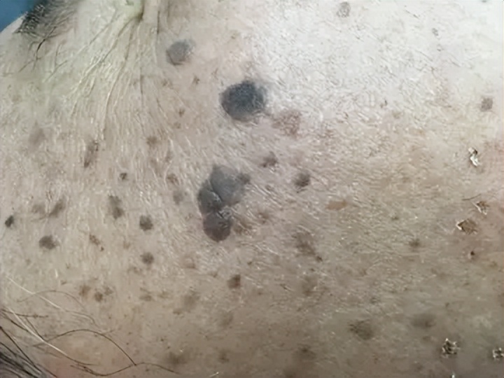 老年斑和色素沉着怎么治,老年人色素沉着怎么去除