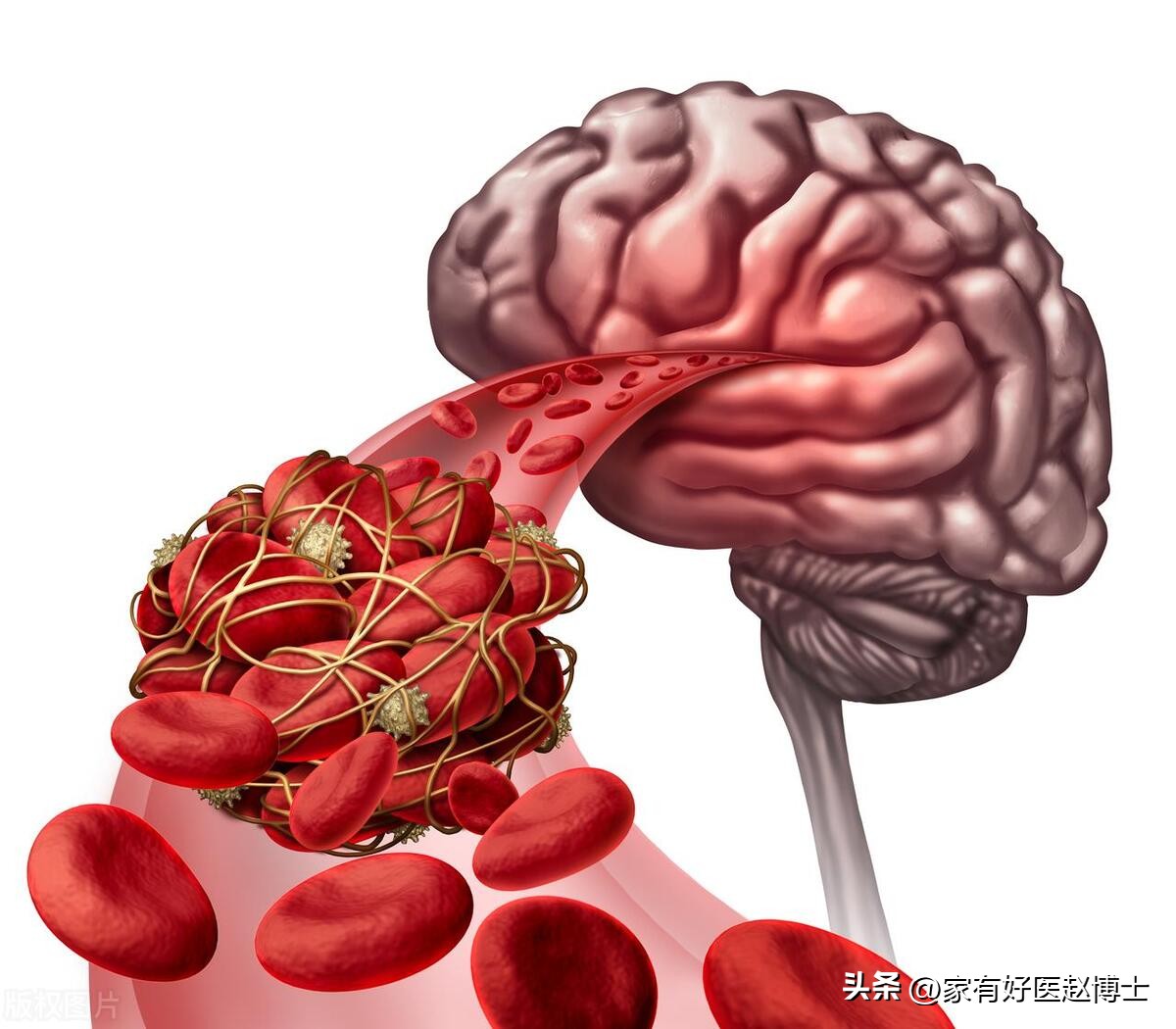 有过一次房颤就必须吃抗凝药吗,偶尔一次房颤可以治愈吗