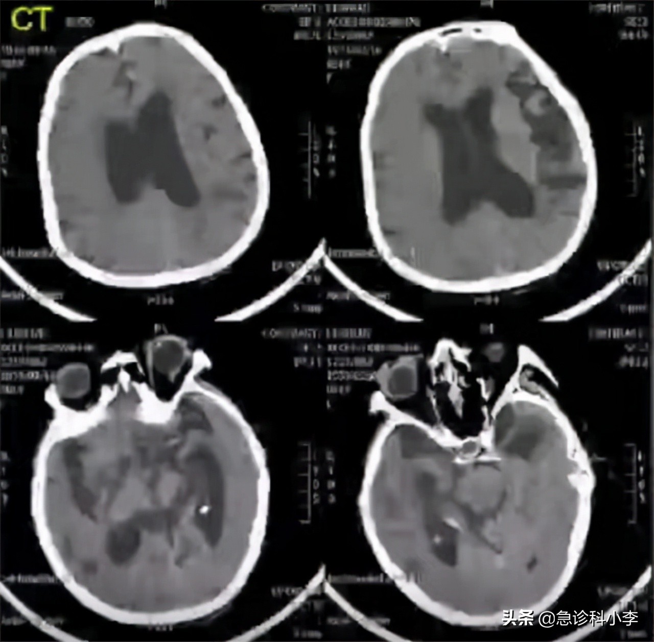脑梗来临前腿脚先知,睡觉时出现5种迹象警惕脑梗信号