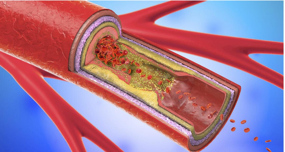 血脂高就不能吃肉,血脂高就不能吃甜食吗
