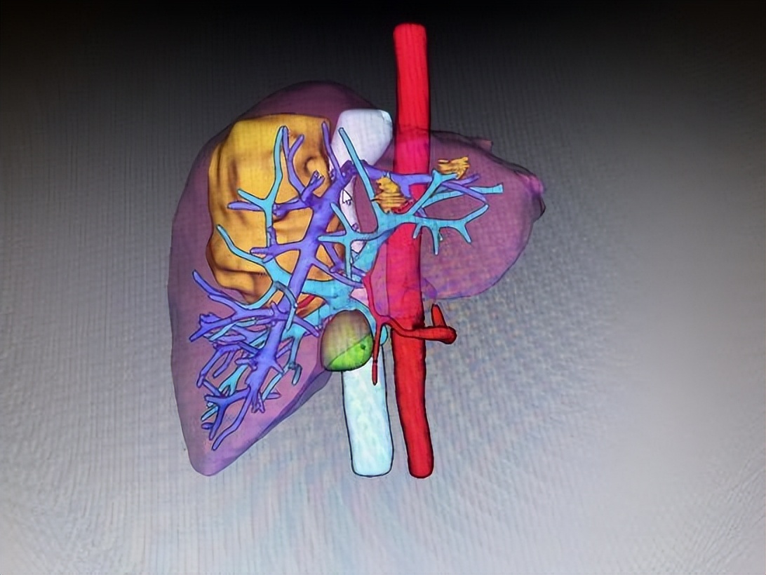 哈医大一院做脑血管瘤,哈医大一院肝脏微创外科