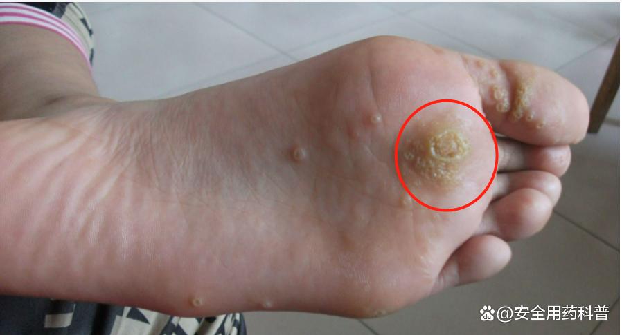 身上的四种疣,身上有很多种疣怎么治疗