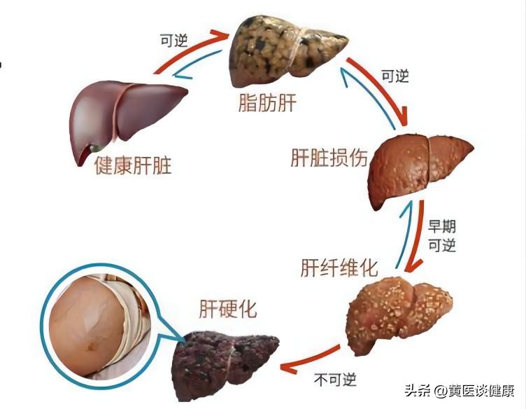 乙肝早期肝硬化伴有脂肪肝严重吗,乙肝肝硬化伴有脂肪肝严重吗